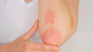 Albue med psoriasis: rødt og flassende utslett. 