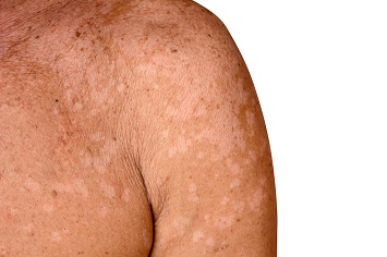 Person med Pityriasis versicolor – hvite pigmentflekker på skulder og overarm.