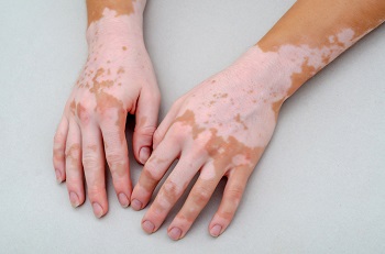Vitiligo på hender: hvite flekker på huden med tap av pigment.