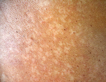 Nærbilde av Pityriasis versicolor - små, hvite pigmentflekker på huden.